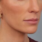 lip-lift-before
