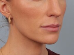 before lip lift