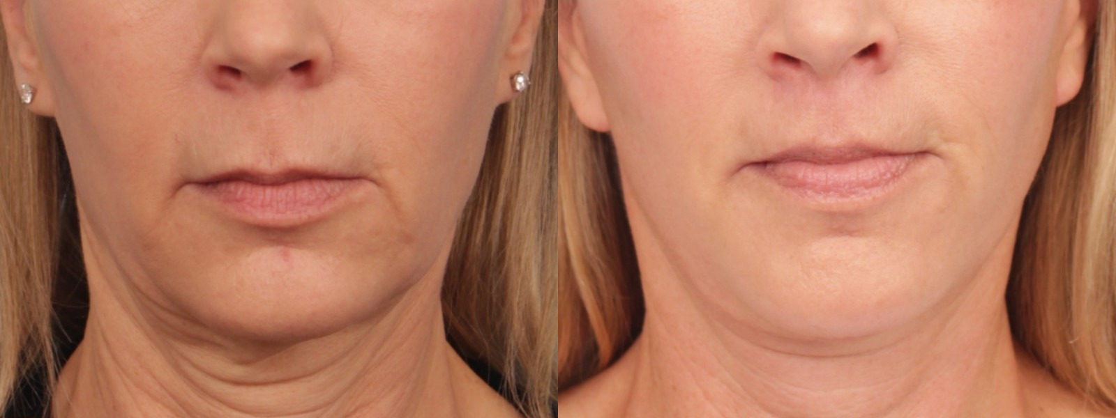 before_after_img