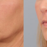 lip-lift-merged