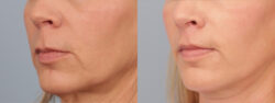 before and after lip lift