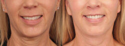 before and after lip lift