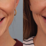 lip-lift-merged