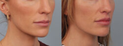 before and after lip lift