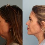 facelift-merged