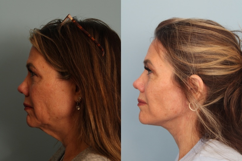 before_after_img