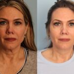 facelift-merged
