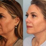 facelift-merged