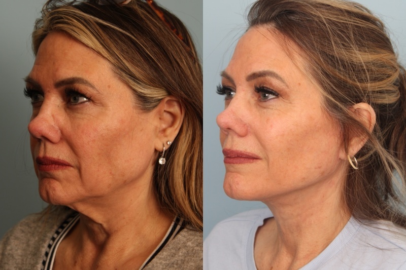 before_after_img