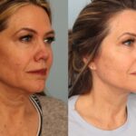 facelift-merged