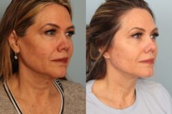before and after facelift