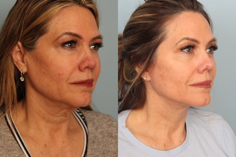 before_after_img