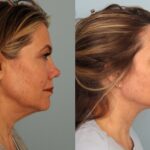 facelift-merged