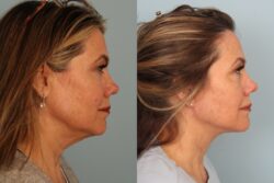 before and after facelift