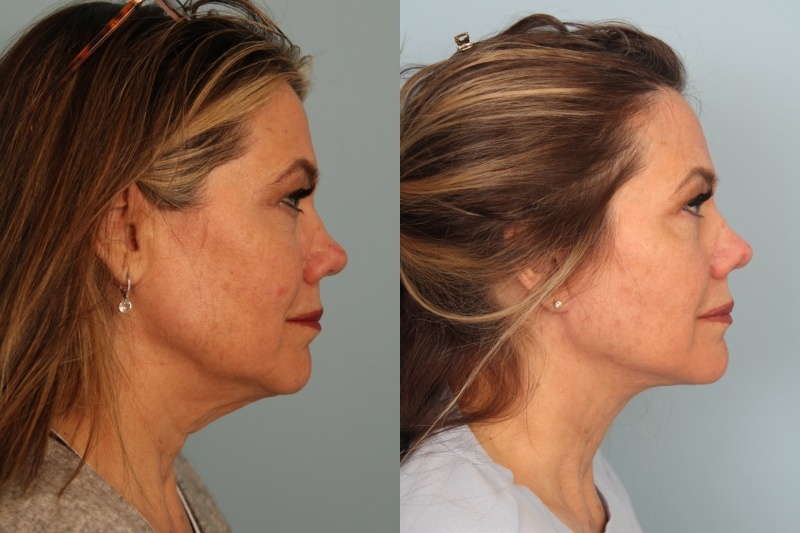 before_after_img