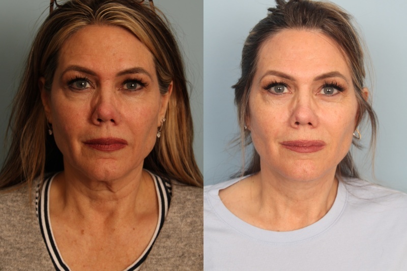 before_after_img