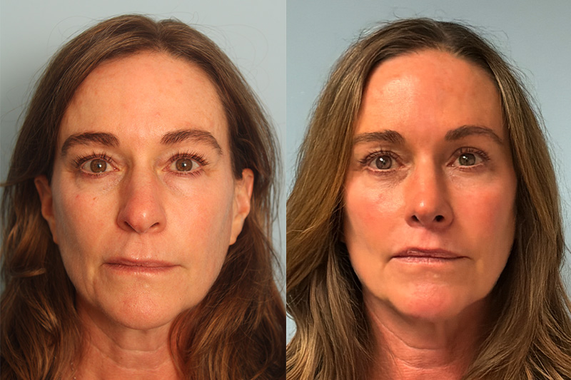 before_after_img