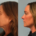 FacesFirst-Gallery-Rhinoplasty-167-Left