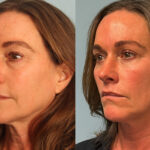 FacesFirst-Gallery-Rhinoplasty-167-Left-OBL