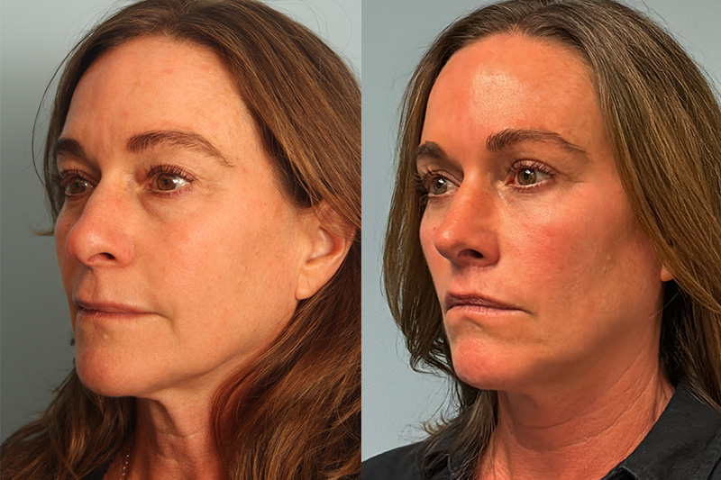 before_after_img
