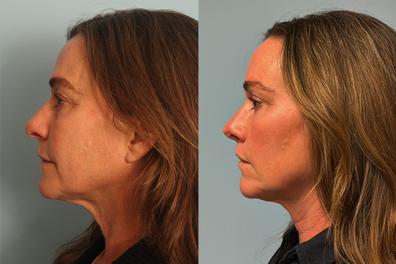 before_after_img