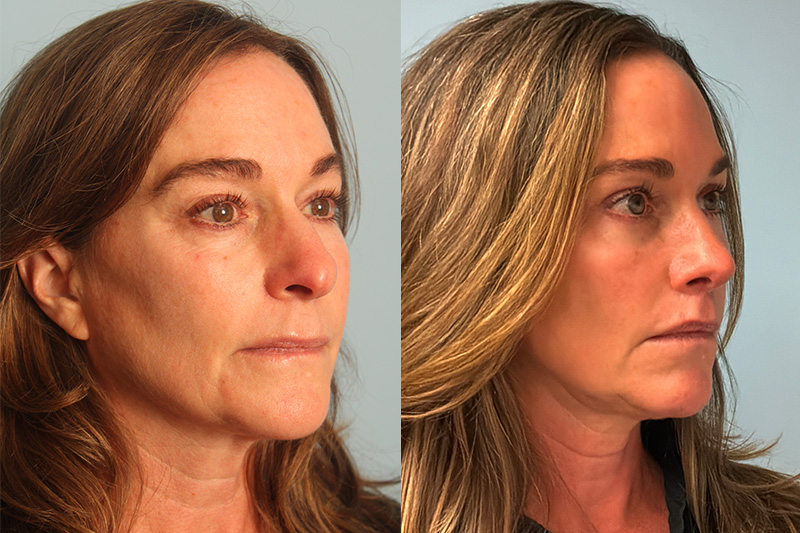 before_after_img