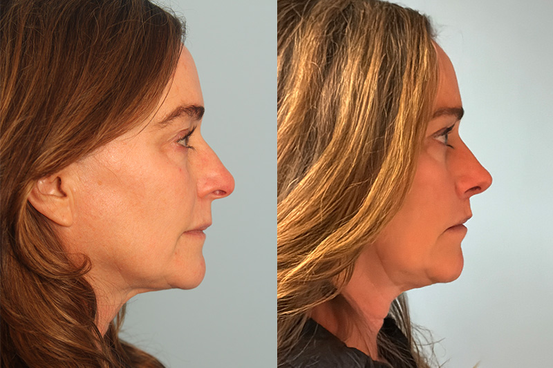 before_after_img