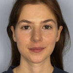 rhinoplasty-after
