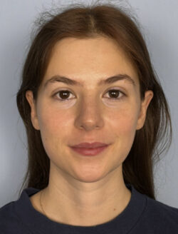after rhinoplasty