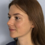 rhinoplasty-after