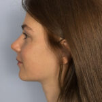 rhinoplasty-after