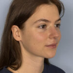 rhinoplasty-after