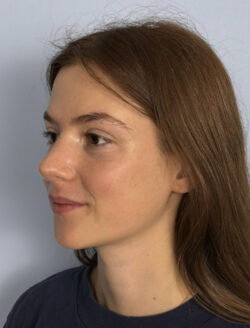 after rhinoplasty