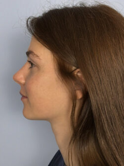 after rhinoplasty