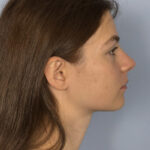 rhinoplasty-after