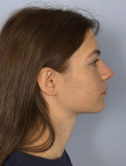 after rhinoplasty