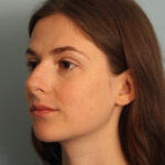 rhinoplasty-before