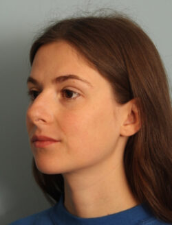 before rhinoplasty