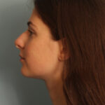 rhinoplasty-before
