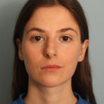rhinoplasty-before