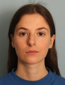 before rhinoplasty