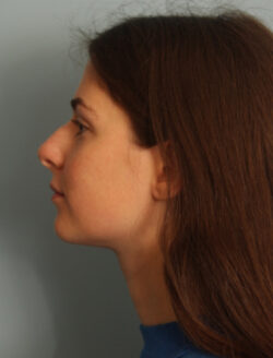 before rhinoplasty
