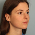 rhinoplasty-before