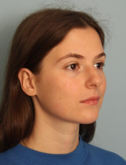 before rhinoplasty