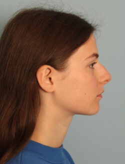 before rhinoplasty