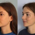 rhinoplasty-merged