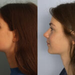 rhinoplasty-merged