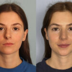 rhinoplasty-merged