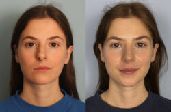 before and after rhinoplasty