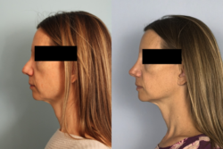 before and after rhinoplasty